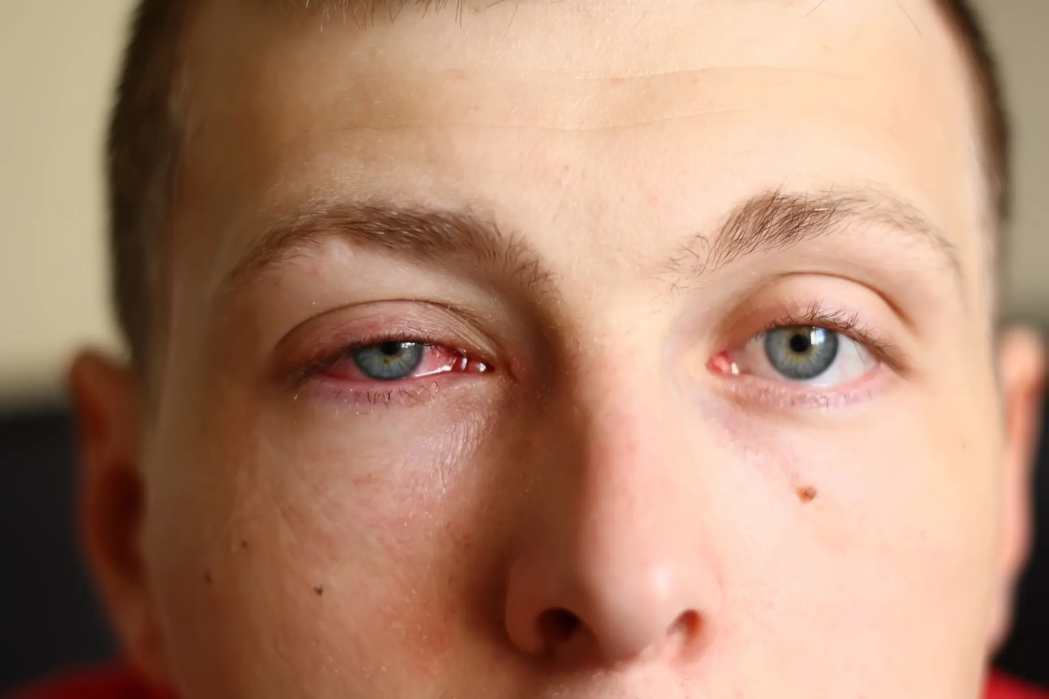 Conjunctivitis treatment
