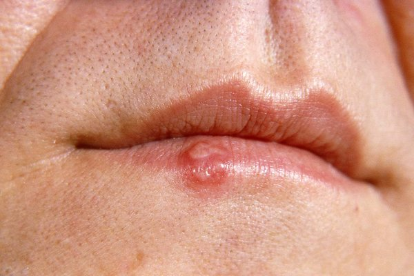 Herpes labialis treatment