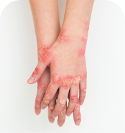 Dermatitis treatment
